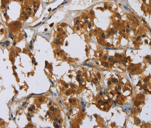 Immunohistochemistry of paraffin-embedded Human thyroid cancer tissue using GATA5 Polyclonal Antibody at dilution 1:50