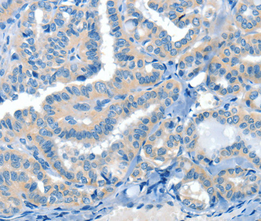 Immunohistochemistry of paraffin-embedded Human thyroid cancer tissue using CRLF2 Polyclonal Antibody at dilution 1:60