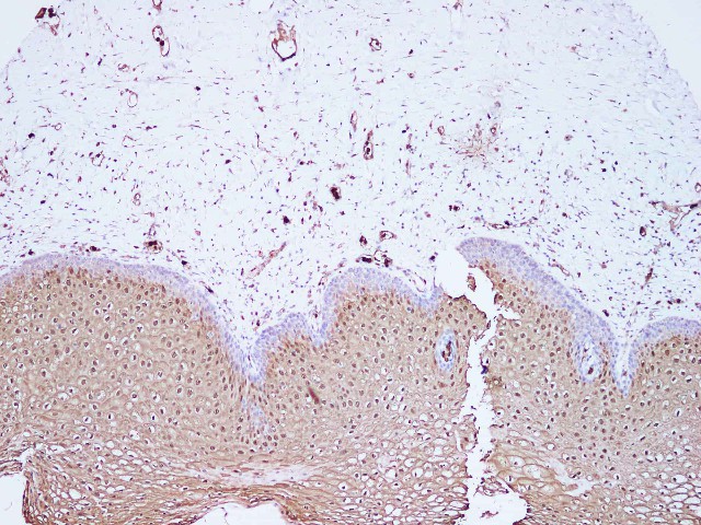 Immunohistochemistry of paraffin-embedded Human cervix using S100A8 Polyclonal Antibody at dilution of 1:100(100?)