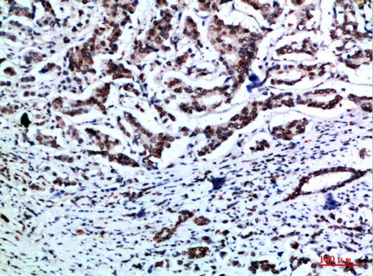 Immunohistochemistry of paraffin-embedded Human breast cancer tissue using Vimentin Polyclonal Antibody at dilution of 1:200.