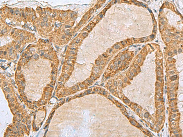 Immunohistochemistry of paraffin-embedded Human thyroid cancer tissue  using PREPL Polyclonal Antibody at dilution of 1:55(?200)