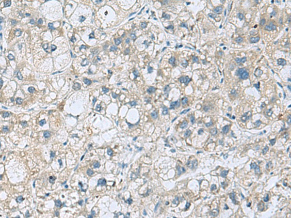 Immunohistochemistry of paraffin-embedded Human liver cancer tissue  using KCNJ2 Polyclonal Antibody at dilution of 1:35(?200)