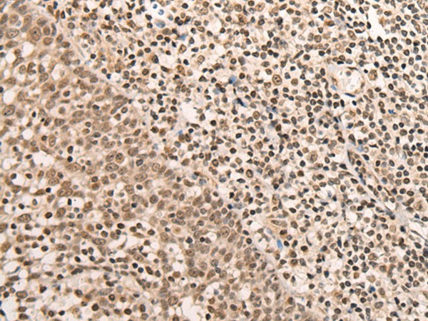 Immunohistochemistry of paraffin-embedded Human tonsil tissue  using ARID1B Polyclonal Antibody at dilution of 1:40(?200)