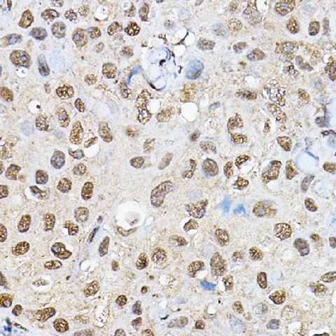 Immunohistochemistry of paraffin-embedded human breast cancer using p70 S6 Kinase 1 1 Polyclonal Antibody at dilution of 1:100 (40x lens).Perform high pressure antigen retrieval with 10 mM citrate buffer pH 6.0 before commencing with IHC staining protocol