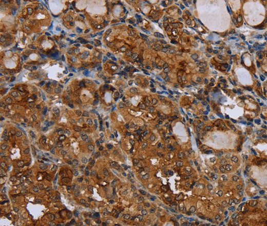 Immunohistochemistry of paraffin-embedded Human thyroid cancer using CD116 Polyclonal Antibody at dilution of 1:35