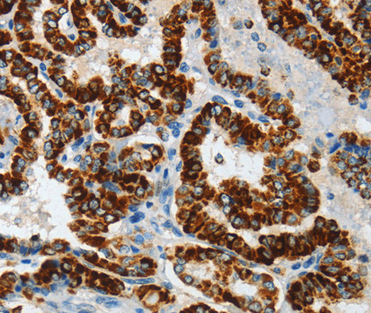 Immunohistochemistry of paraffin-embedded Human thyroid cancer tissue using ASB4 Polyclonal Antibody at dilution 1:40