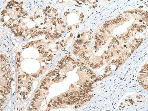 Immunohistochemistry of paraffin-embedded Human colorectal cancer tissue  using ZNF83 Polyclonal Antibody at dilution of 1:50(?200)