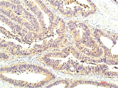 Immunohistochemistry of paraffin-embedded Human colon tissue using STAT1 Monoclonal Antibody at dilution of 1:200.