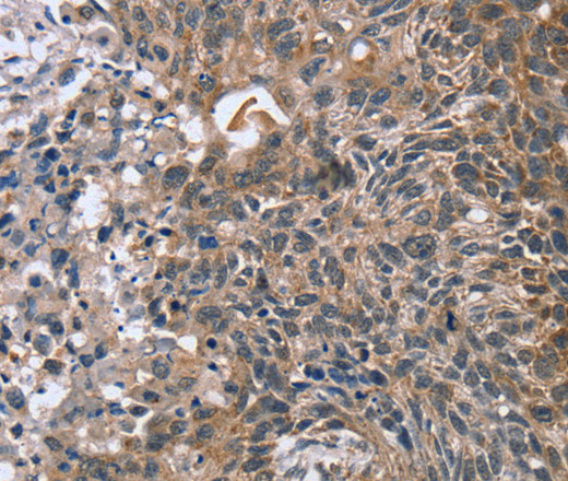 Immunohistochemistry of paraffin-embedded Human esophagus cancer using RASSF7 Polyclonal Antibody at dilution of 1:45