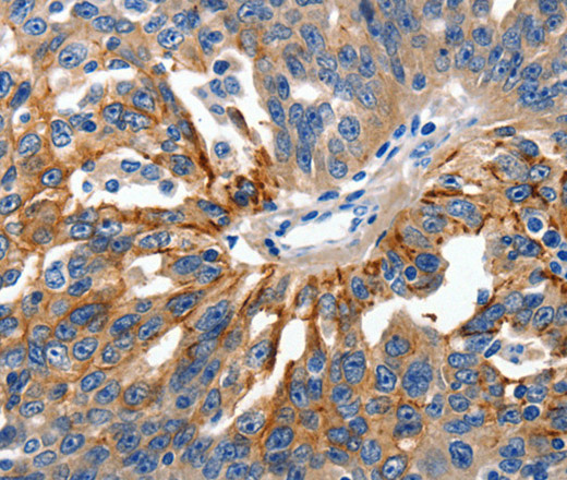 Immunohistochemistry of paraffin-embedded Human ovarian cancer using Claudin 1 Polyclonal Antibody at dilution of 1:150