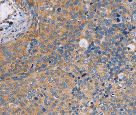 Immunohistochemistry of paraffin-embedded Human cervical cancer tissue using NEK8 Polyclonal Antibody at dilution 1:30