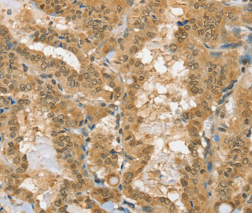 Immunohistochemistry of paraffin-embedded Human thyroid cancer using PSMC1 Polyclonal Antibody at dilution of 1:40