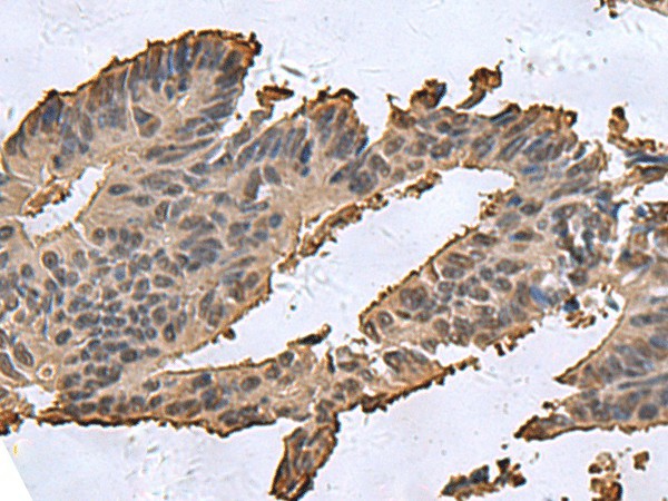 Immunohistochemistry of paraffin-embedded Human colorectal cancer tissue  using DCTPP1 Polyclonal Antibody at dilution of 1:85(?200)