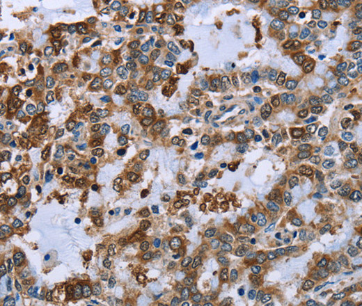 Immunohistochemistry of paraffin-embedded Human liver cancer using IMPDH2 Polyclonal Antibody at dilution of 1:60