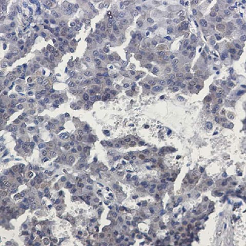 Immunohistochemistry of TORC2 in paraffin-embedded Human breast cancer tissue using TORC2 Rabbit mAb at dilution 1:50