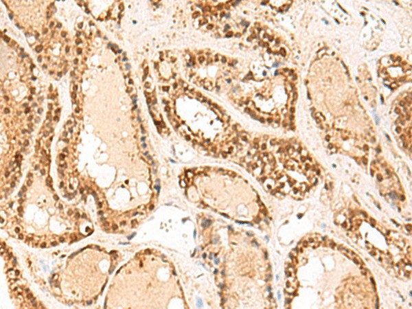 Immunohistochemistry of paraffin-embedded Human thyroid cancer tissue  using FUNDC2 Polyclonal Antibody at dilution of 1:60(?200)