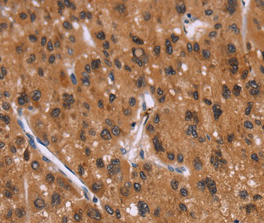 Immunohistochemistry of paraffin-embedded Human liver cancer tissue using ID2 Polyclonal Antibody at dilution 1:30