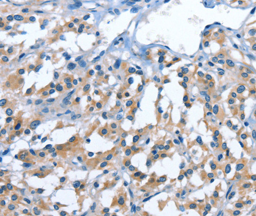 Immunohistochemistry of paraffin-embedded Human thyroid cancer tissue using PAK6 Polyclonal Antibody at dilution 1:40