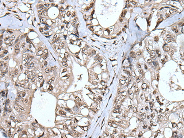 Immunohistochemistry of paraffin-embedded Human colorectal cancer tissue  using TIA1 Polyclonal Antibody at dilution of 1:55(?200)