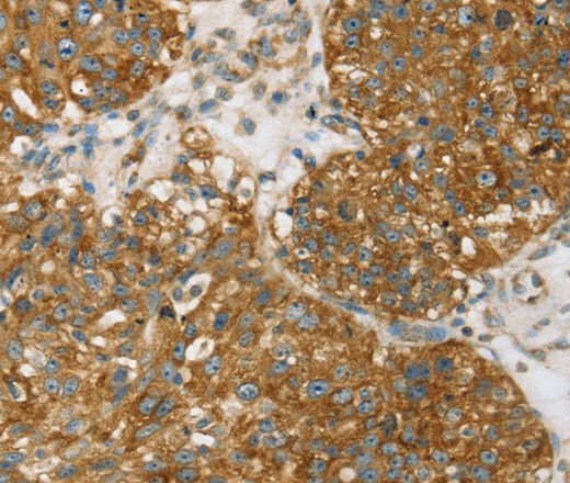 Immunohistochemistry of paraffin-embedded Human breast cancer using TPD54 Polyclonal Antibody at dilution of 1:35