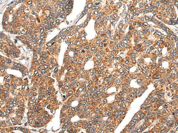 Immunohistochemistry of paraffin-embedded Human liver cancer tissue  using EPHA6 Polyclonal Antibody at dilution of 1:25(?200)