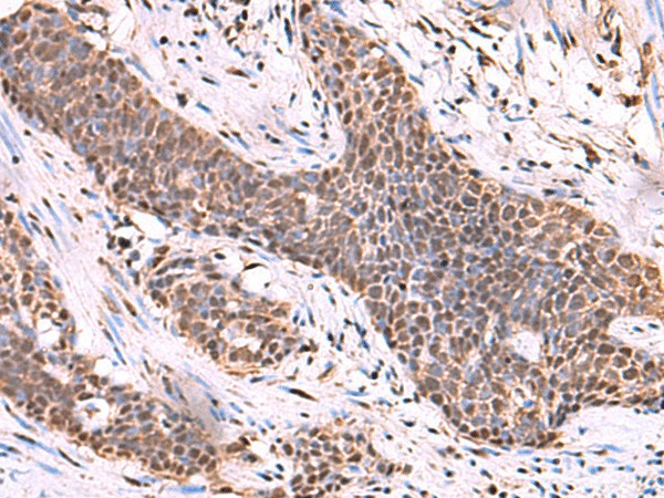 Immunohistochemistry of paraffin-embedded Human esophagus cancer tissue  using SCCPDH Polyclonal Antibody at dilution of 1:50(?200)