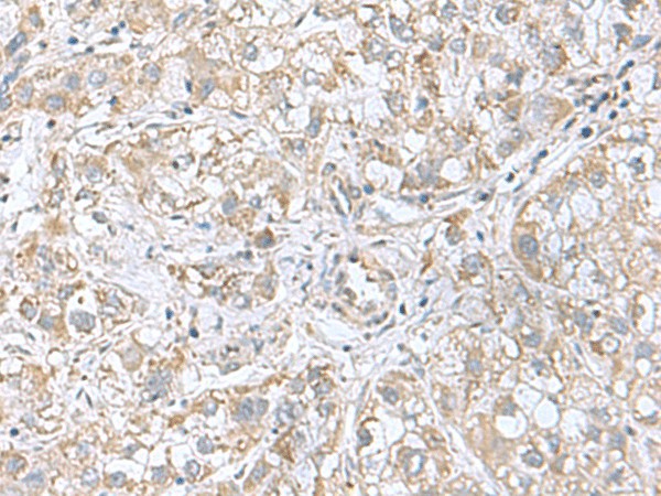 Immunohistochemistry of paraffin-embedded Human liver cancer tissue  using CGB5 Polyclonal Antibody at dilution of 1:55(?200)