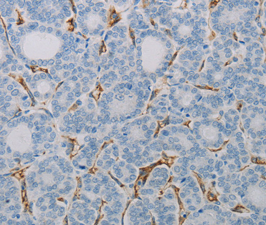 Immunohistochemistry of paraffin-embedded Human thyroid cancer tissue using CD31 Polyclonal Antibody at dilution 1:40