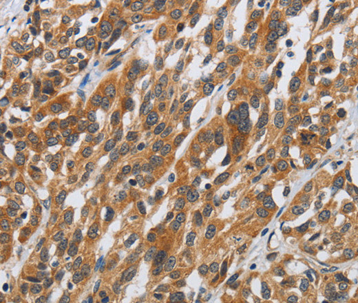 Immunohistochemistry of paraffin-embedded Human esophagus cancer tissue using DSP Polyclonal Antibody at dilution 1:40