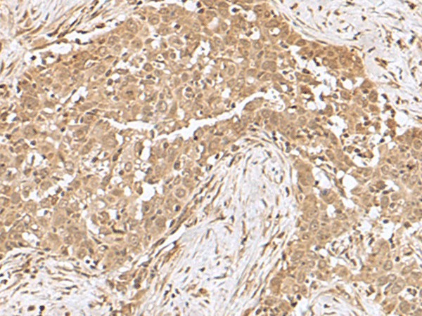 Immunohistochemistry of paraffin-embedded Human esophagus cancer tissue  using RCHY1 Polyclonal Antibody at dilution of 1:50(?200)