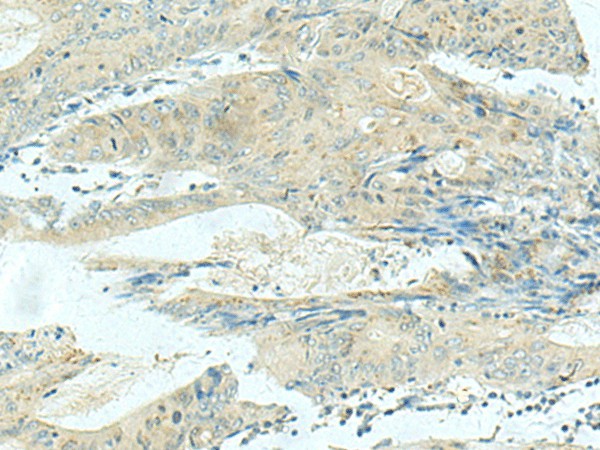 Immunohistochemistry of paraffin-embedded Human colorectal cancer tissue  using KIF21B Polyclonal Antibody at dilution of 1:40(?200)