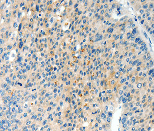 Immunohistochemistry of paraffin-embedded Human liver cancer using TPM2 Polyclonal Antibody at dilution of 1:60