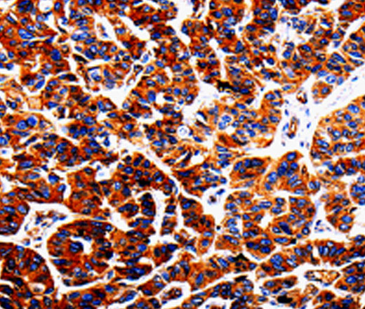 Immunohistochemistry of paraffin-embedded Human lung cancer tissue using ADD1 Polyclonal Antibody at dilution 1:50