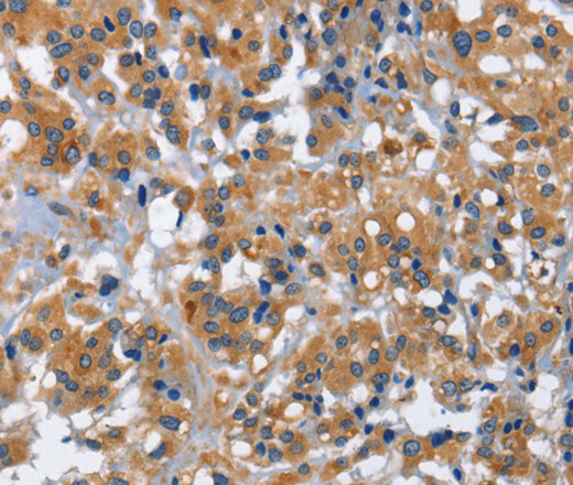 Immunohistochemistry of paraffin-embedded Human thyroid cancer using IL2RB Polyclonal Antibody at dilution of 1:30