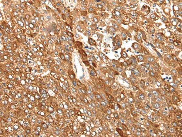 Immunohistochemistry of paraffin-embedded Human liver cancer tissue  using CAD Polyclonal Antibody at dilution of 1:50(?200)