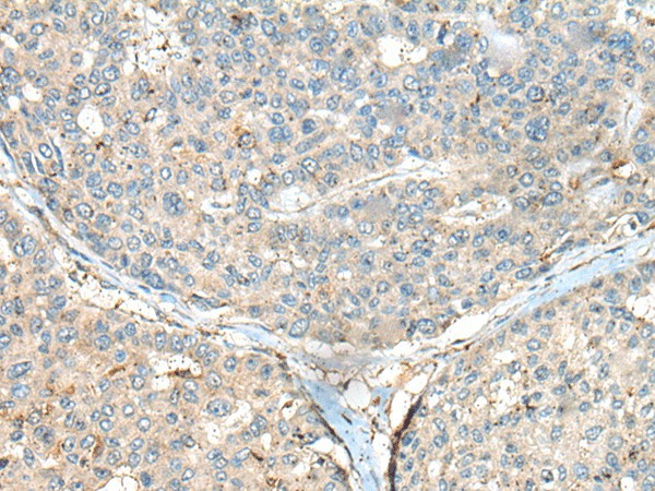 Immunohistochemistry of paraffin-embedded Human liver cancer tissue  using CASR Polyclonal Antibody at dilution of 1:60(?200)