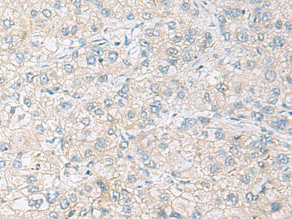 Immunohistochemistry of paraffin-embedded Human liver cancer tissue  using FARP2 Polyclonal Antibody at dilution of 1:70(?200)