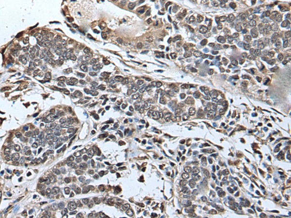 Immunohistochemistry of paraffin-embedded Human esophagus cancer tissue  using SLITRK5 Polyclonal Antibody at dilution of 1:45(?200)