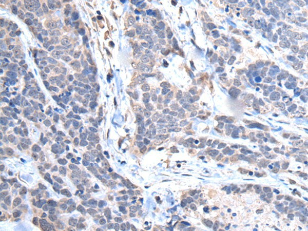 Immunohistochemistry of paraffin-embedded Human thyroid cancer tissue  using TRIM27 Polyclonal Antibody at dilution of 1:65(?200)