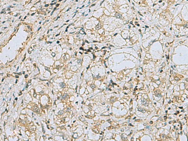 Immunohistochemistry of paraffin-embedded Human liver cancer tissue  using RAB3IP Polyclonal Antibody at dilution of 1:60(?200)