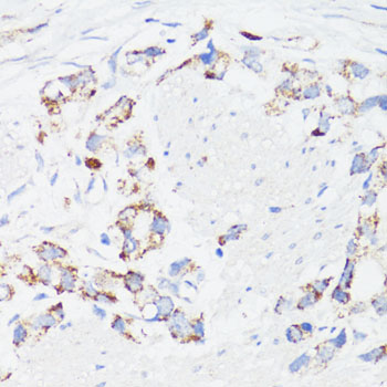 Immunohistochemistry of paraffin-embedded Human gastric cancer using EGFR Polyclonal Antibody at dilution of 1:150 (40x lens).