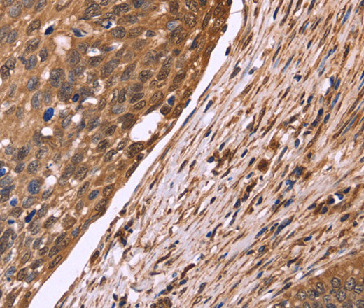 Immunohistochemistry of paraffin-embedded Human cervical cancer tissue using CDC37L1 Polyclonal Antibody at dilution 1:50