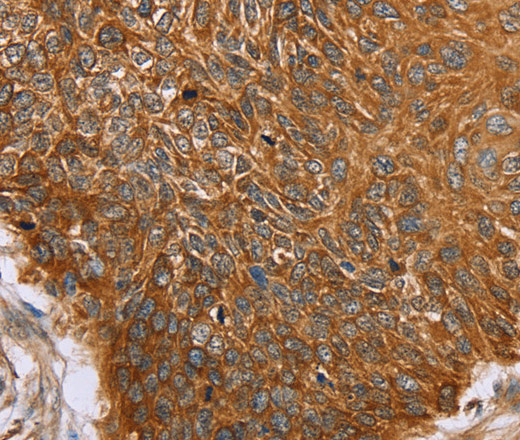 Immunohistochemistry of paraffin-embedded Human esophagus cancer using PAICS Polyclonal Antibody at dilution of 1:50