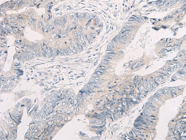 Immunohistochemistry of paraffin-embedded Human colorectal cancer tissue  using WNK4 Polyclonal Antibody at dilution of 1:45(?200)