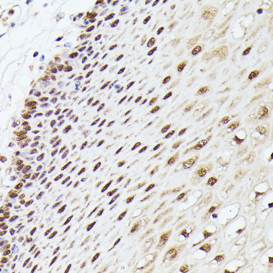 Immunohistochemistry of paraffin-embedded Human esophageal using MLF2 Polyclonal Antibody at dilution of  1:100 (40x lens).