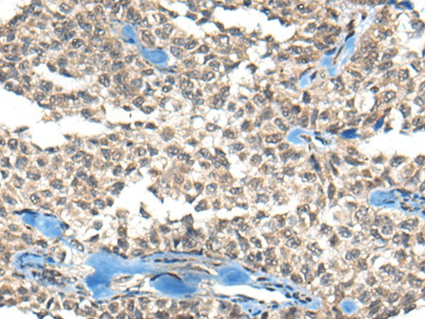 Immunohistochemistry of paraffin-embedded Human ovarian cancer tissue  using REST Polyclonal Antibody at dilution of 1:50(?200)