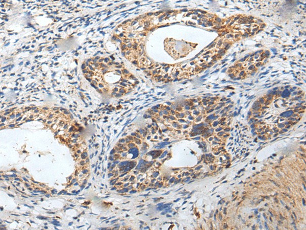 Immunohistochemistry of paraffin-embedded Human cervical cancer tissue  using ZPBP Polyclonal Antibody at dilution of 1:30(?200)