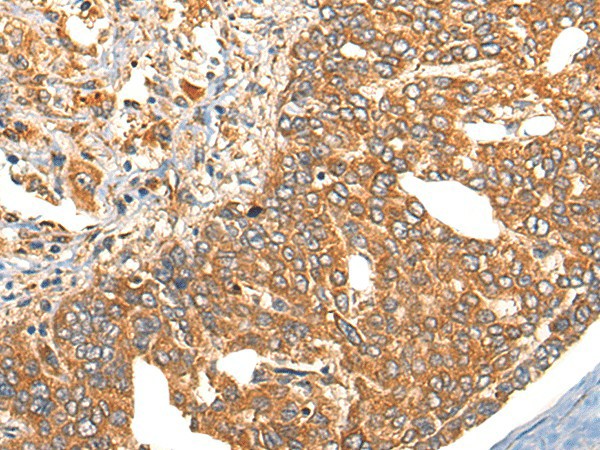 Immunohistochemistry of paraffin-embedded Human liver cancer tissue  using UBIAD1 Polyclonal Antibody at dilution of 1:40(?200)