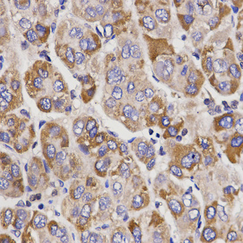 Immunohistochemistry of paraffin-embedded human liver cancer using UGT1A9 Polyclonal Antibody at dilution of 1:200 (40x lens).Perform microwave antigen retrieval with 10 mM PBS buffer pH 7.2 before commencing with IHC staining protocol.