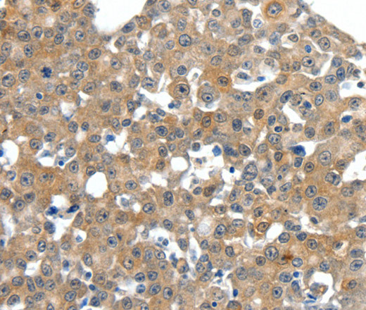 Immunohistochemistry of paraffin-embedded Human esophagus cancer tissue using SCN11A Polyclonal Antibody at dilution 1:40